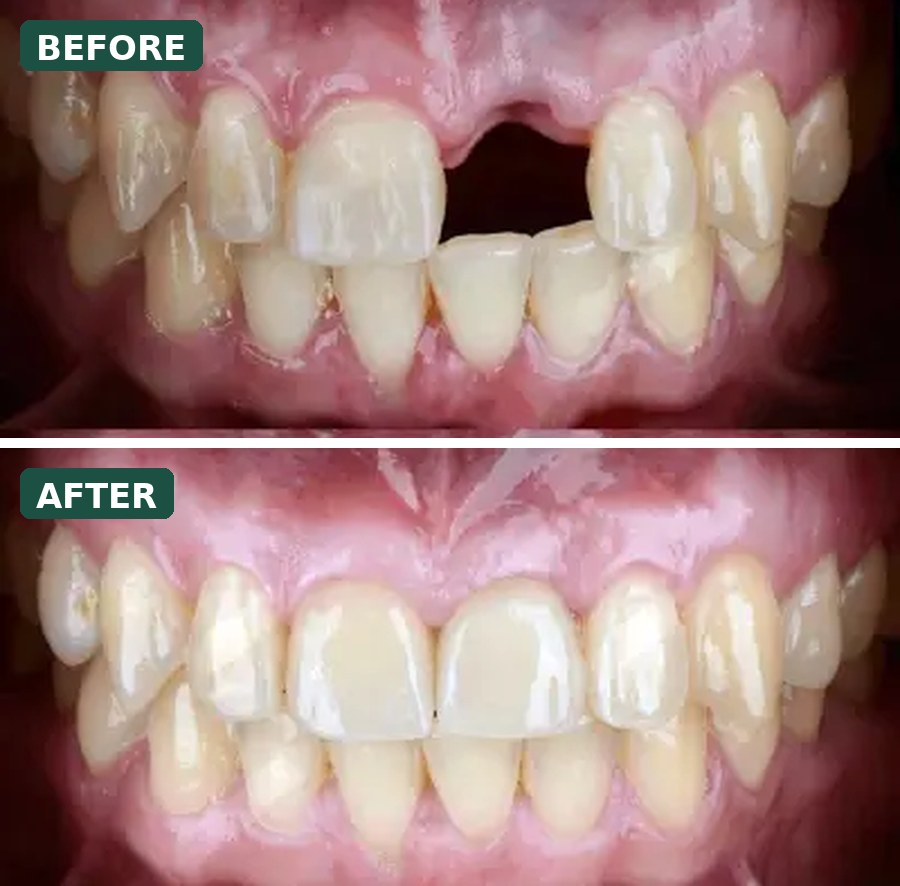 Missing-tooth restoration before and after