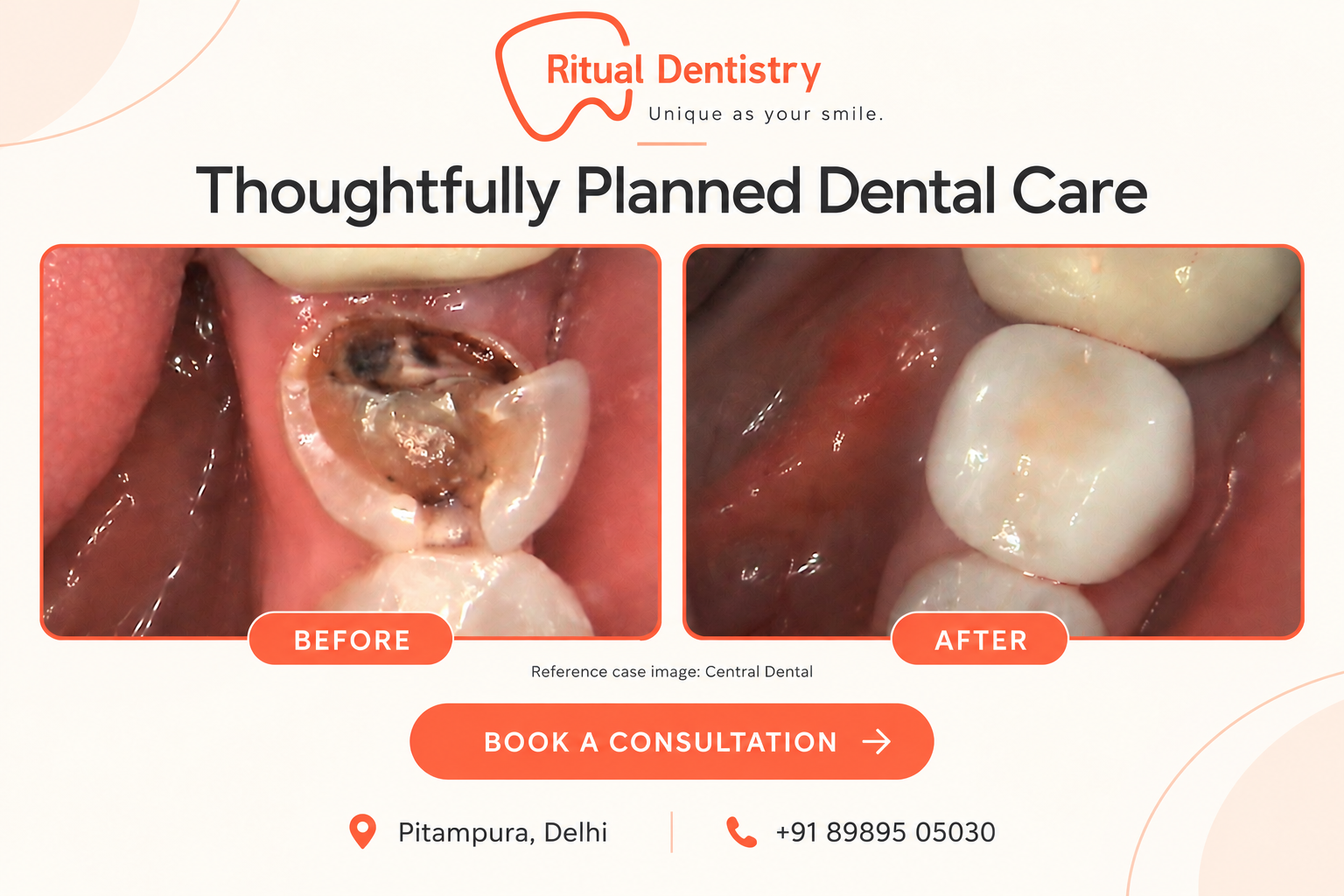 Root canal treatment case before and after