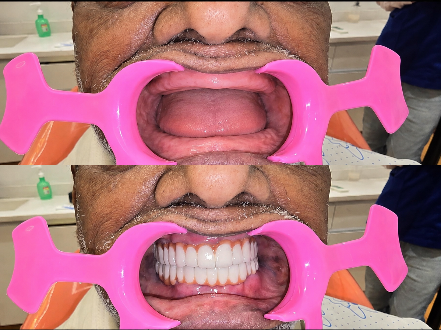 Full mouth rehabilitation before and after result at Ritual Dentistry, Pitampura