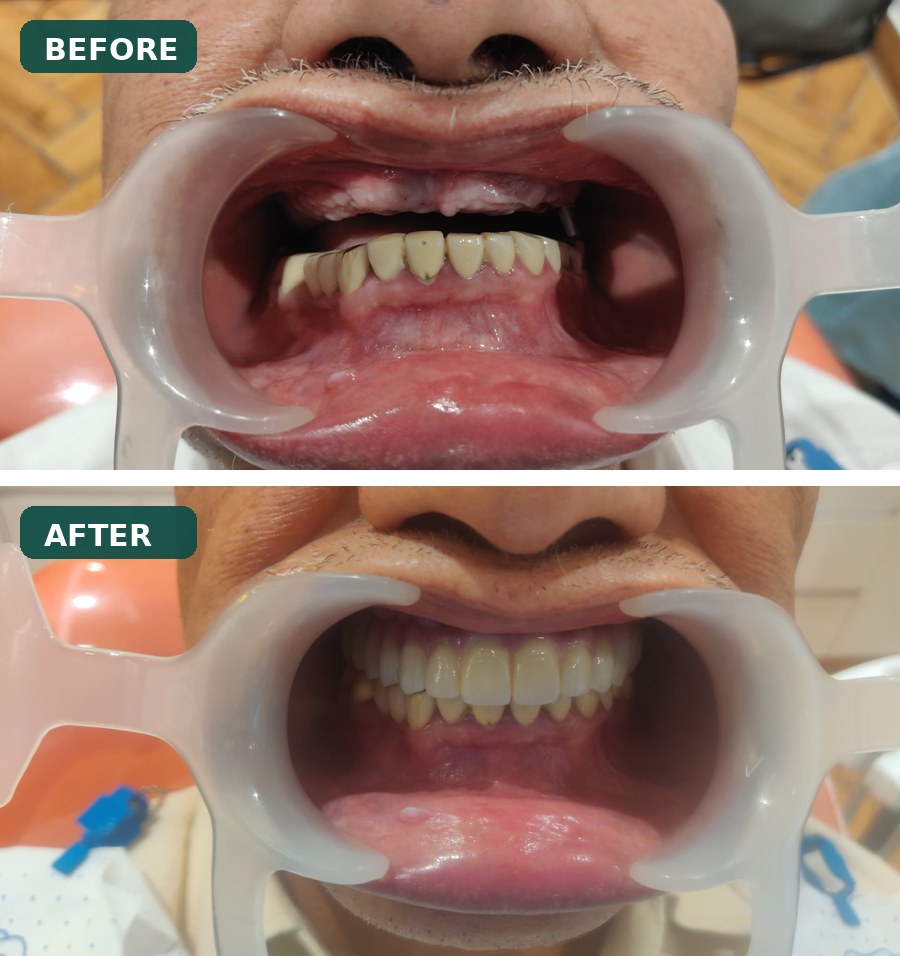 Dental Implants before and after