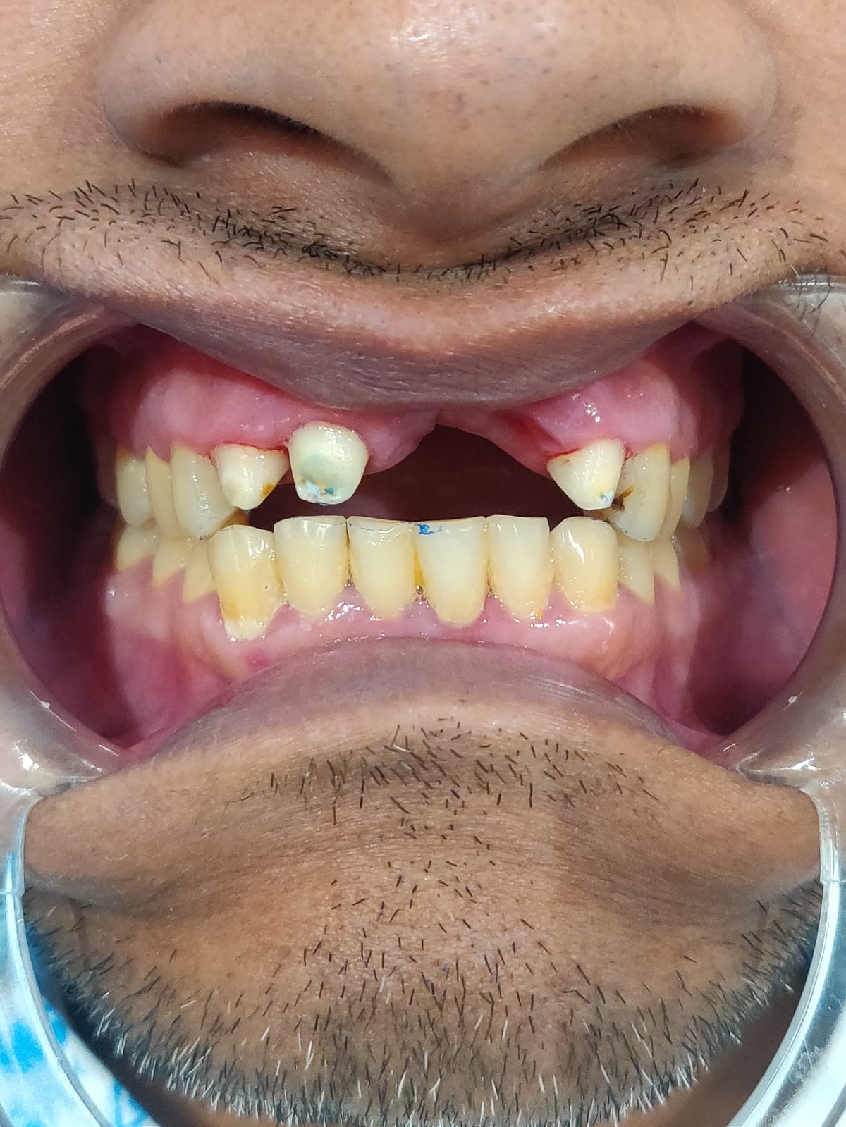 Patient smile before treatment at Ritual Dentistry