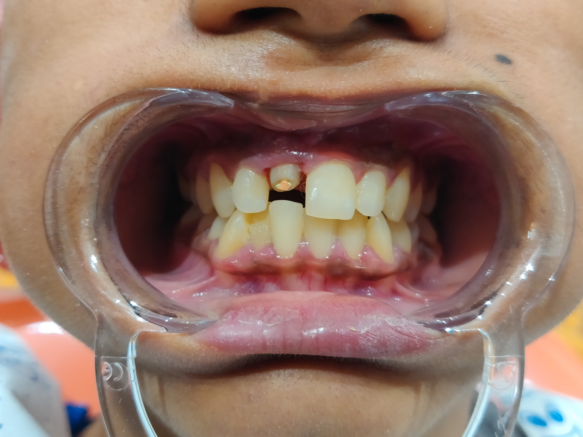 Patient smile before treatment at Ritual Dentistry