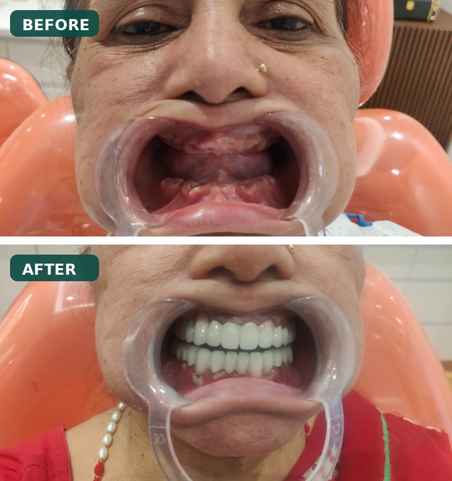 Dental Implants before and after