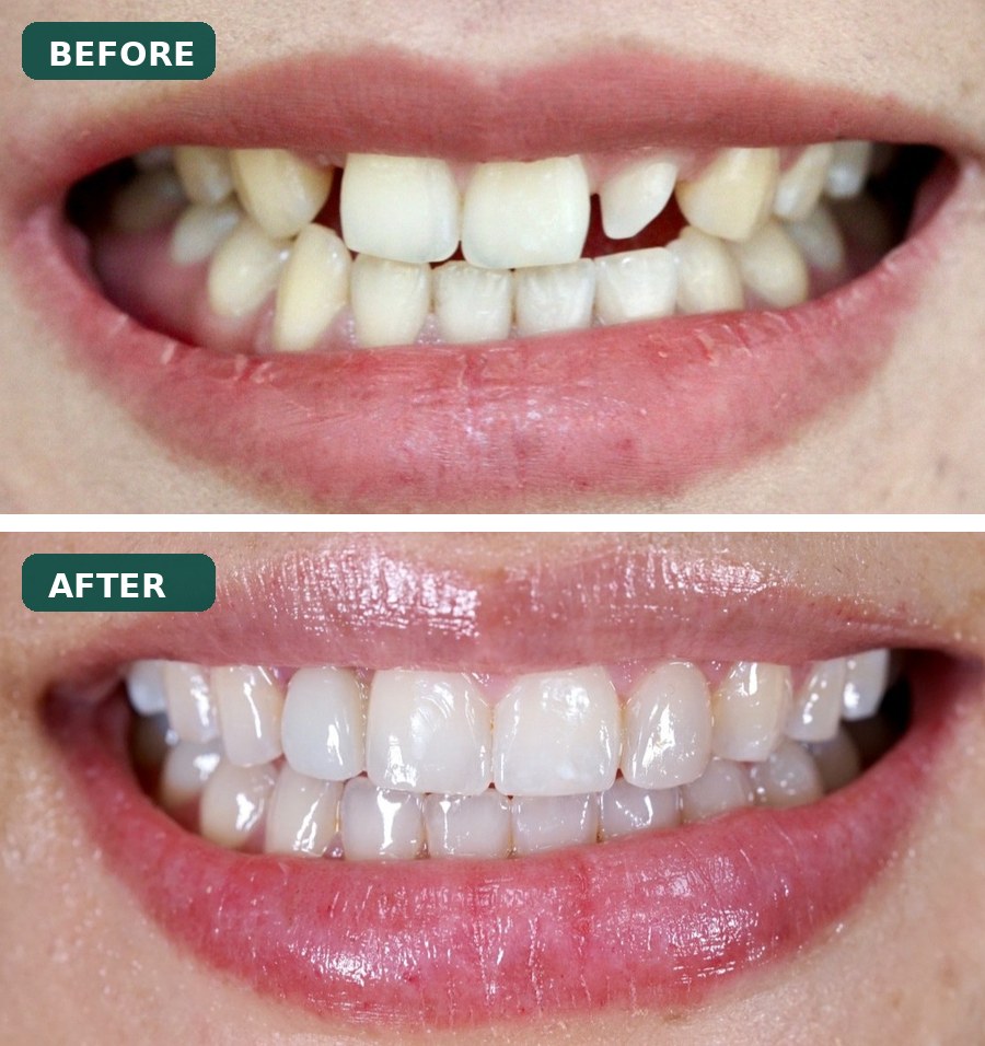 Smile transformation before and after