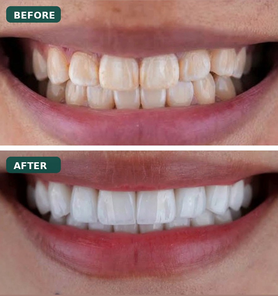 Dental Implants before and after
