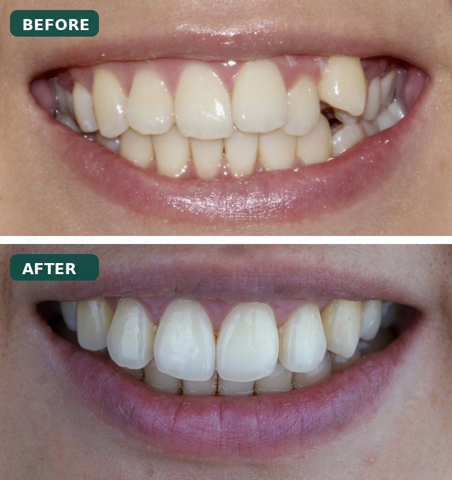 Dental Implants before and after