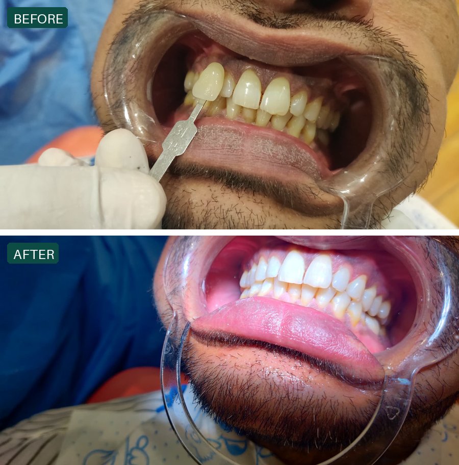 In-clinic whitening case — before and after treatment