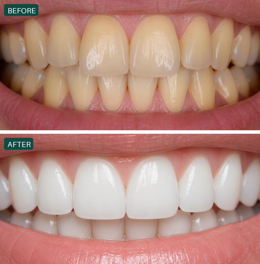 Illustrative whitening example — before and after treatment